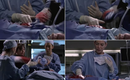 Meredith places her hand in the chest cavity twice